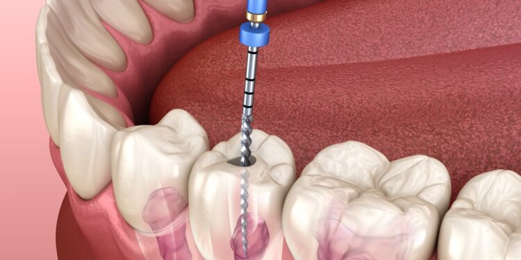 Do root canals cause health problems