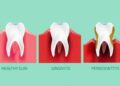 Can dental crowns cause health problems