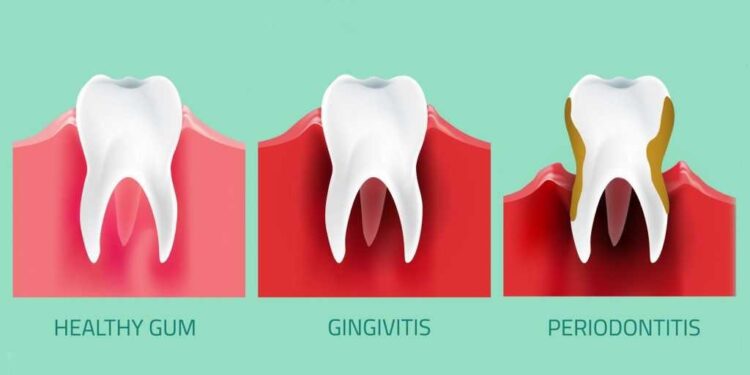 Can dental crowns cause health problems