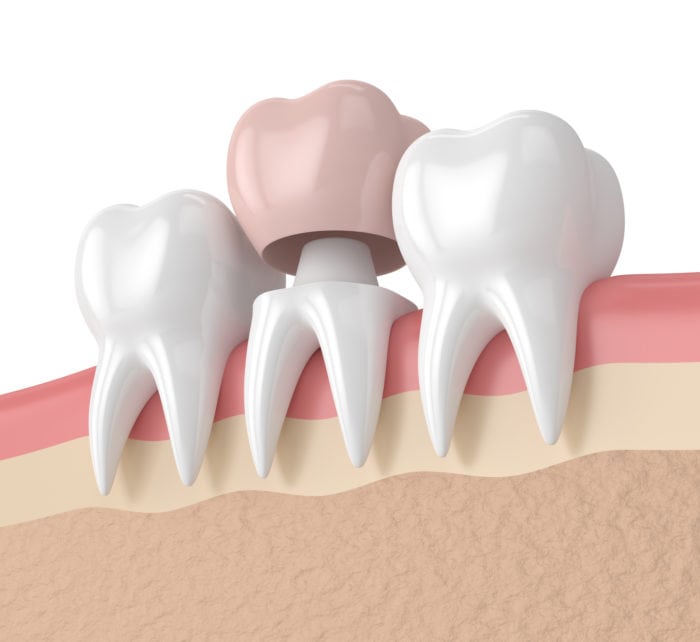 Can dental crowns cause health problems Best in 2025